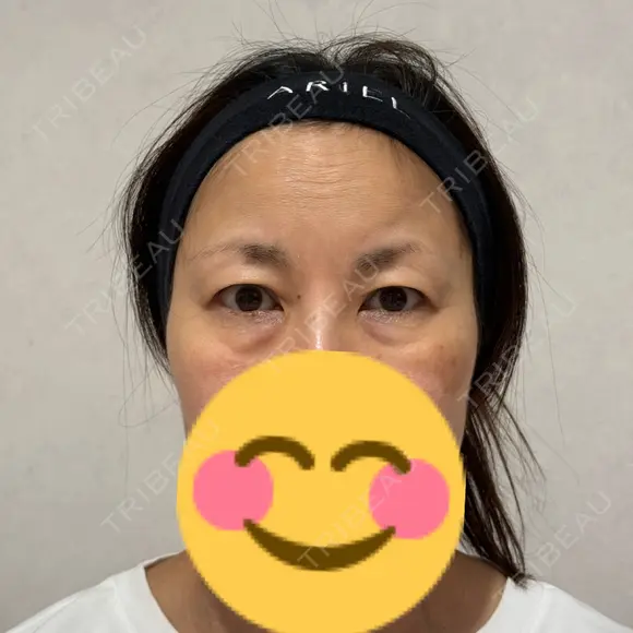 クマ治療 アリエル美容クリニック 横浜院 BEFORE メイン用