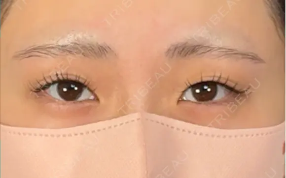 二重埋没 / 上まぶたの脂肪取り アリエル美容クリニック 大宮院 BEFORE メイン用