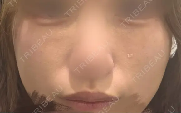 毛穴洗浄（ハイドラフェイシャルなど） / ルメッカ 大美会クリニック 天王寺院 BEFORE メイン用