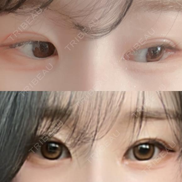 二重埋没 ASTRA BEAUTY CLINIC BEFORE メイン用