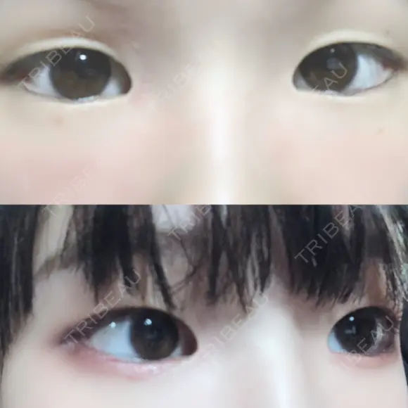 その他（目元） ばん皮膚科 BEFORE メイン用
