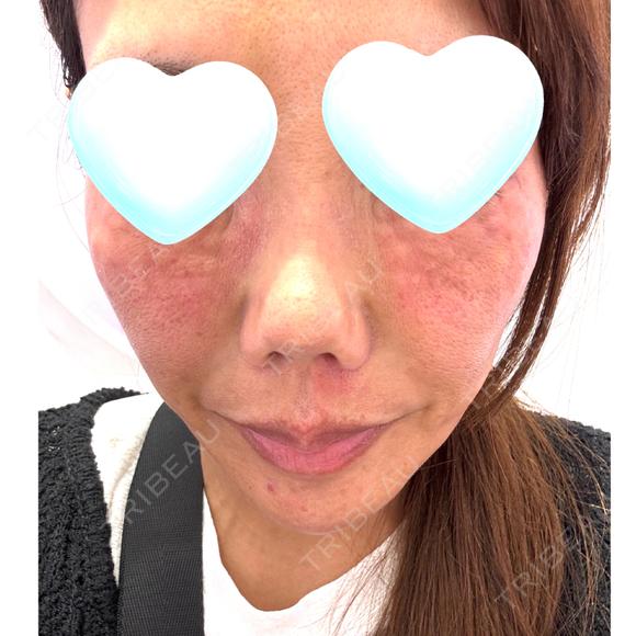 水光注射（ハリ・美肌） Natural Skin Clinic 自由ヶ丘院 BEFORE メイン用