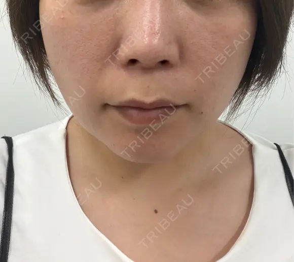 シワ取りボトックス / 肌育注射（ジュベルックなど） / ピコレーザートーニング（美白・肝斑） / ピコスポット 東京シルククリニック 新宿院 BEFORE メイン用
