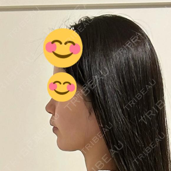 イオン導入 / デンシティ Belle Via Clinic BEFORE メイン用
