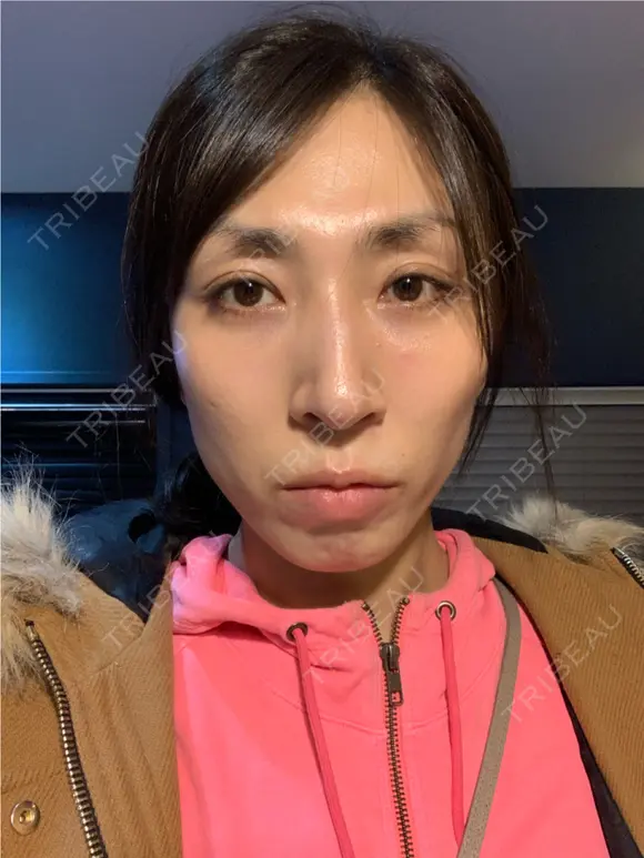 骨切り（あご） / 骨削り（エラ） / 骨削り（頬） / 脂肪注入（輪郭） バノバギ整形外科 BEFORE メイン用
