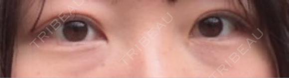クマ治療 / 脂肪注入（目の下） NARU Beauty Clinic 【ナルクリ】 BEFORE メイン用