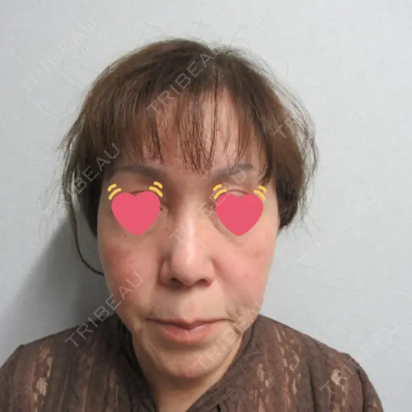 肌ヒアルロン酸注入（たるみ・シワ改善） ジョウクリニック 姫路院 BEFORE メイン用