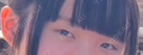 二重埋没 アリエル美容クリニック 郡山院 BEFORE メイン用