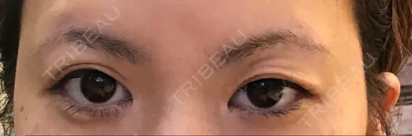 二重切開 / その他（目元） RG整形外科（旧リオン整形外科） BEFORE メイン用