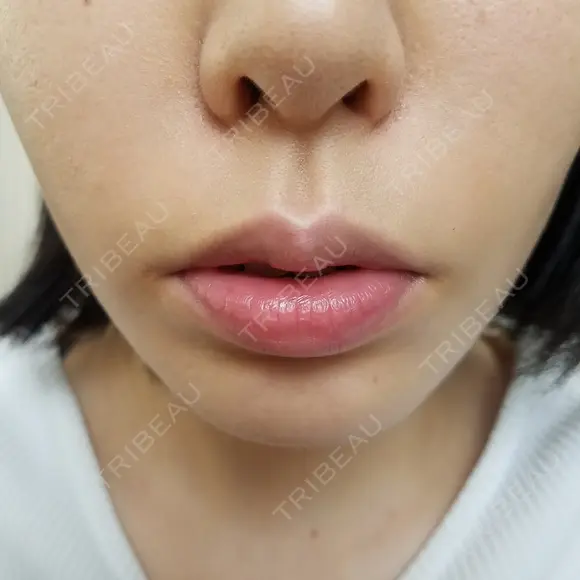 人中短縮 CLASSY 仙台美容外科・美容皮膚科 BEFORE メイン用