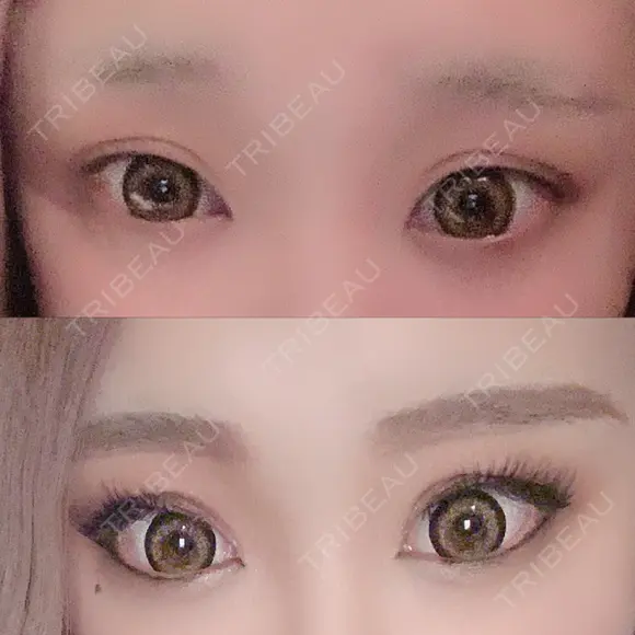 二重埋没 広島プルミエクリニック BEFORE メイン用