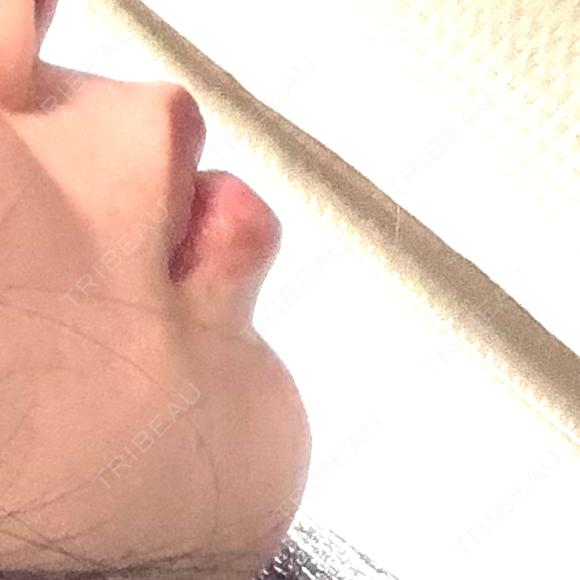ヒアルロン酸注入（あご） / ボトックス（エラ・小顔） ルラ美容クリニック 仙台院 / ルラスキンクリニック 仙台院 BEFORE メイン用