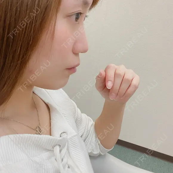 隆鼻術 / 鼻尖形成（切開） サラ美容外科 BEFORE メイン用