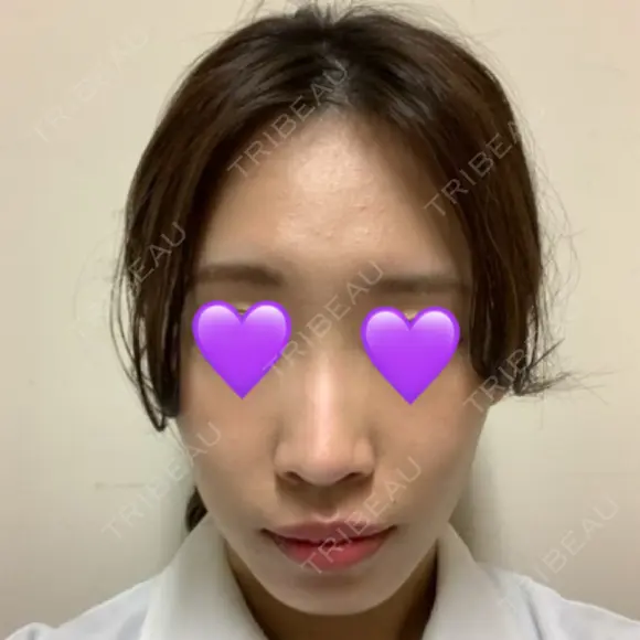 鼻尖形成（切開） / ヒアルロン酸注入（鼻） 東京ヒルズクリニック 新宿院 BEFORE メイン用