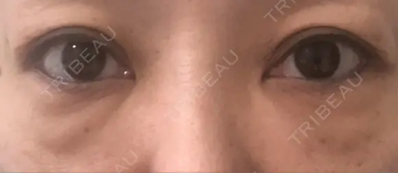 下まぶたたるみ取り セオリークリニック BEFORE メイン用