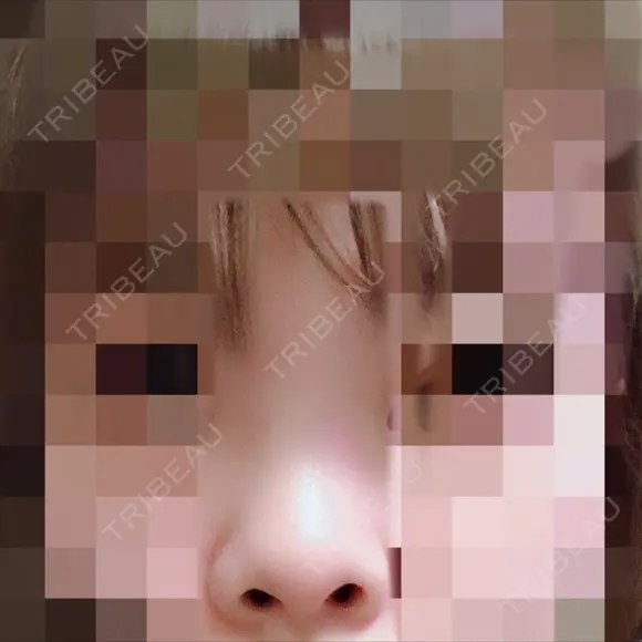 鼻尖形成（切開） / 小鼻縮小（切開） / 軟骨移植 / 眉間プロテーゼ 湘南美容クリニック 広島院 BEFORE メイン用