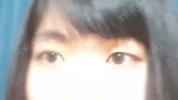 二重埋没 共立美容外科 札幌院 BEFORE メイン用