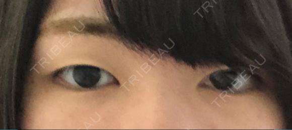 二重埋没 湘南美容クリニック 京都院 BEFORE メイン用