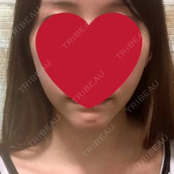 骨切り（あご） / 骨削り（エラ） / 脂肪注入（輪郭） RG整形外科（旧リオン整形外科） BEFORE メイン用