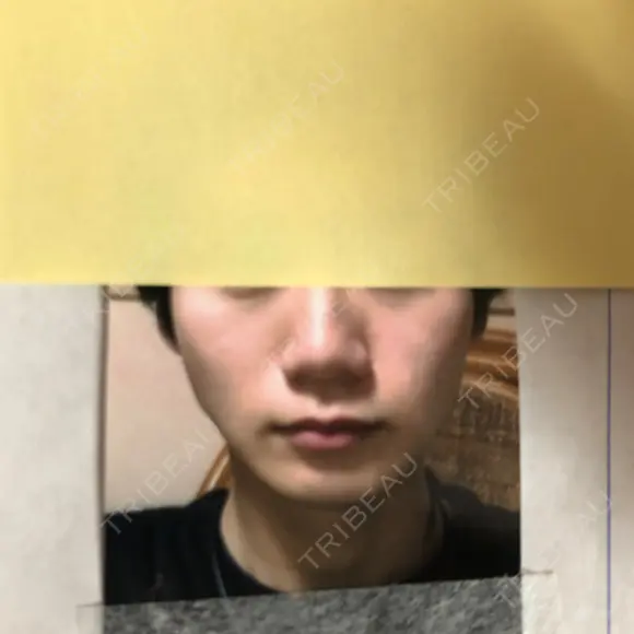 隆鼻術 / 鼻尖形成（切開） / 鼻中隔延長（切開） / 小鼻縮小（切開） / 軟骨移植 / 鼻孔縁挙上 / 鼻尖縮小 Zetith Beauty Clinic 銀座院 BEFORE メイン用