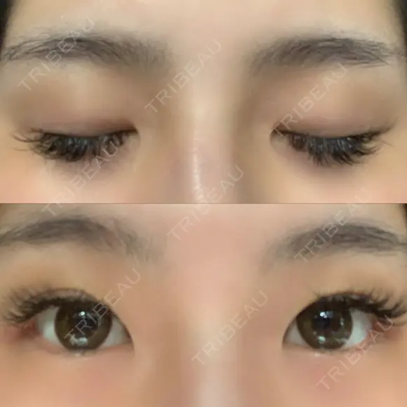 二重埋没 湘南美容歯科 大阪心斎橋院 BEFORE メイン用