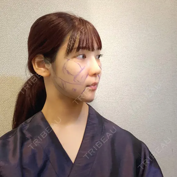 骨削り（頬） / 脂肪吸引（顔） / ボトックス（エラ・小顔） / ボトックス（ふくらはぎ） / ヒアルロン酸注入（額） / ボトックス（肩） RG整形外科（旧リオン整形外科） BEFORE メイン用