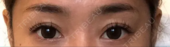 目尻切開 / タレ目形成・グラマラスライン（切開） / ヒアルロン酸注入（涙袋） ジュエリー美容外科 BEFORE メイン用