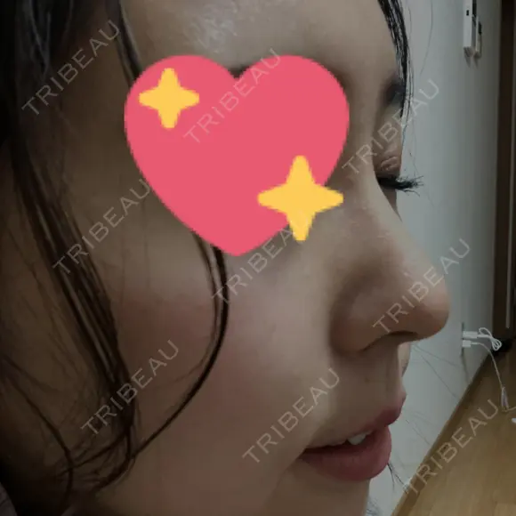 スレッドノーズ キップン整形外科 BEFORE メイン用