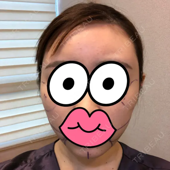 糸リフト / 骨削り（頬） / 脂肪吸引（顔） RG整形外科（旧リオン整形外科） BEFORE メイン用