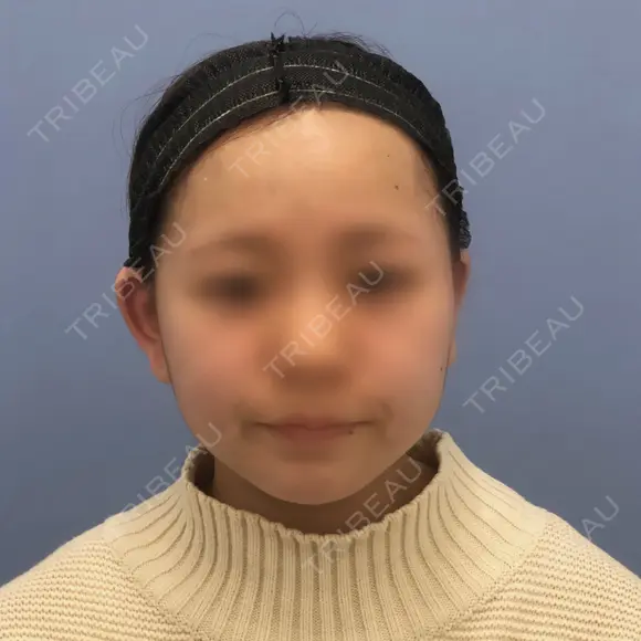 バッカルファット除去 / ボトックス（エラ・小顔） 湘南美容クリニック 秋葉原院 BEFORE メイン用