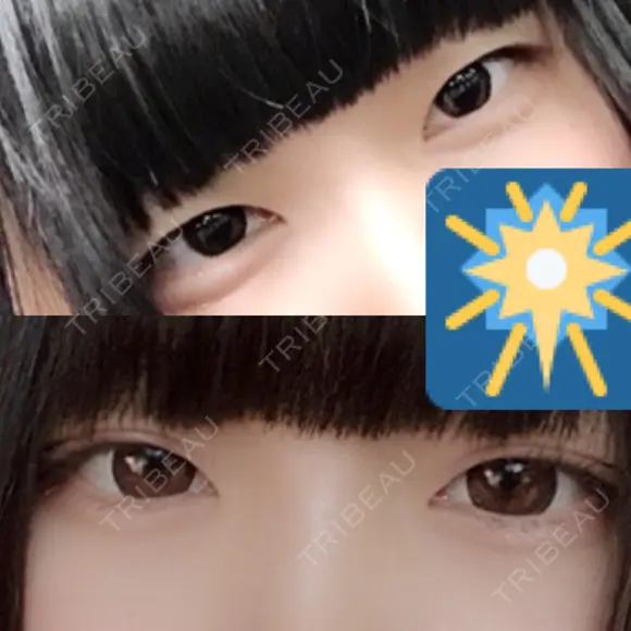 二重埋没 共立美容外科 大分院 BEFORE メイン用