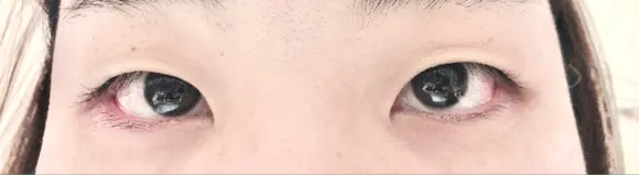 二重埋没 / 上まぶたの脂肪取り TCB東京中央美容外科 江坂院 BEFORE メイン用