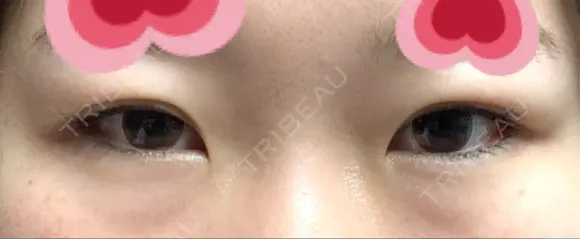 目頭切開 / 下まぶたの脂肪取り / タレ目形成・グラマラスライン（切開） ララ整形外科 BEFORE メイン用