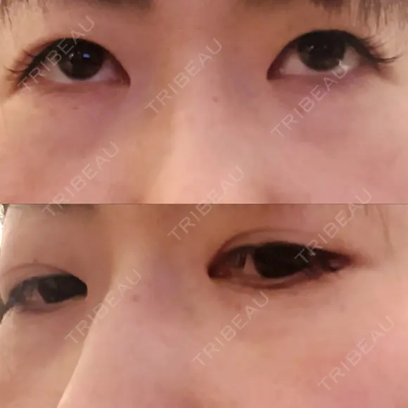 下まぶたの脂肪取り 品川美容外科 渋谷院（※品川スキンクリニック提携） BEFORE メイン用