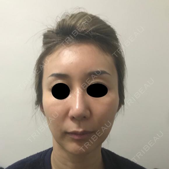 糸リフト / 額を丸く / 人中短縮 / こめかみ形成 / ヒアルロン酸注入（あご） / ボトックス（エラ・小顔） / ヒアルロン酸注入（頬） あきこクリニック BEFORE メイン用