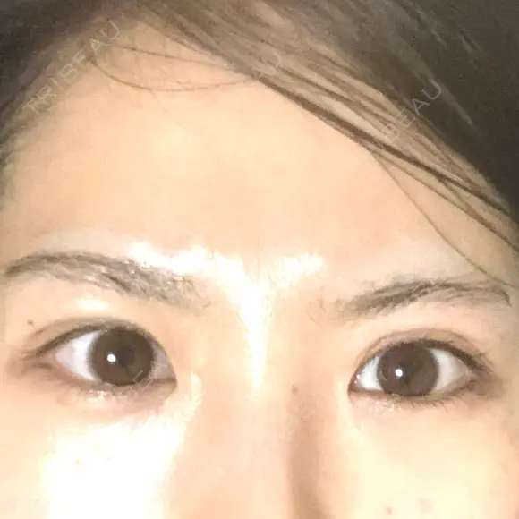 目頭切開 / 上まぶたたるみ取り 湘南美容クリニック 金沢院 BEFORE メイン用