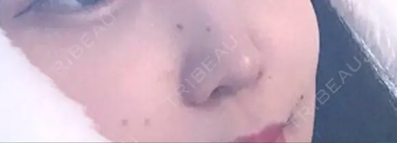 ほくろ・いぼ切除（肌） 赤坂メディカルMクリニック BEFORE メイン用