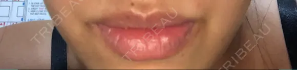 人中短縮 / 口角挙上 / その他（口元） 清潭女神美容外科 BEFORE メイン用