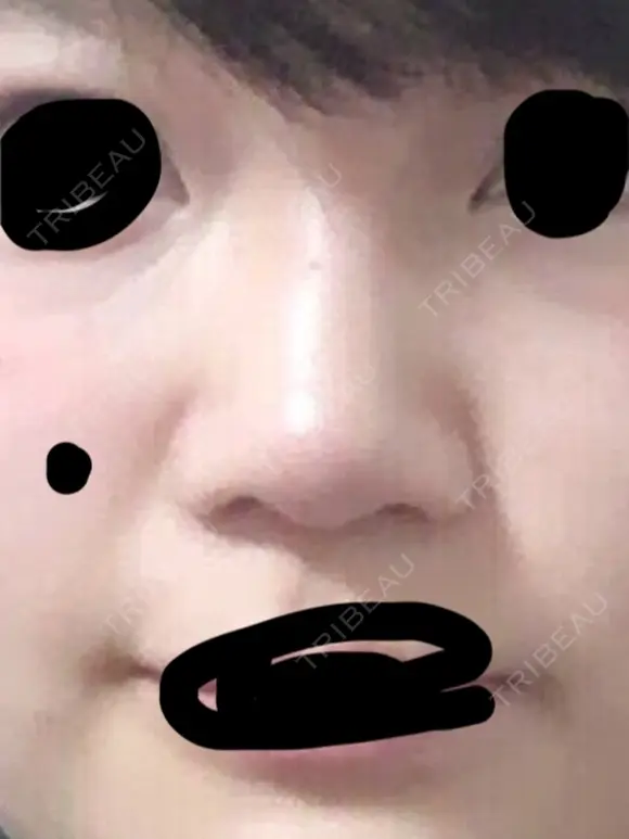 鼻尖形成（切開） 三輪皮フ科形成外科 BEFORE メイン用