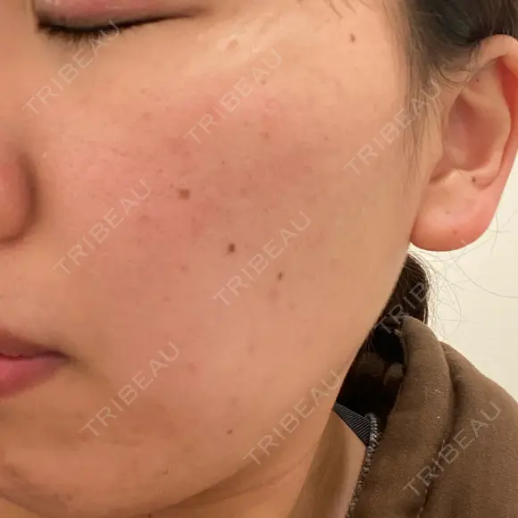 ほくろ・いぼ切除（肌） 赤坂メディカルMクリニック BEFORE メイン用