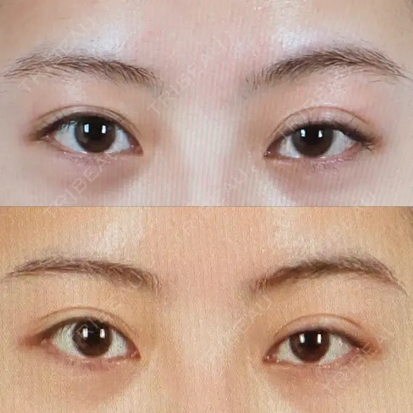 二重切開 / 眼瞼下垂（切開） / 目尻切開 / 上まぶたの脂肪取り / タレ目形成・グラマラスライン（切開） id（アイディ）美容外科 BEFORE メイン用