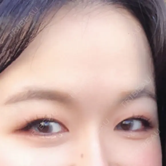 自然癒着法 ララ整形外科 BEFORE メイン用