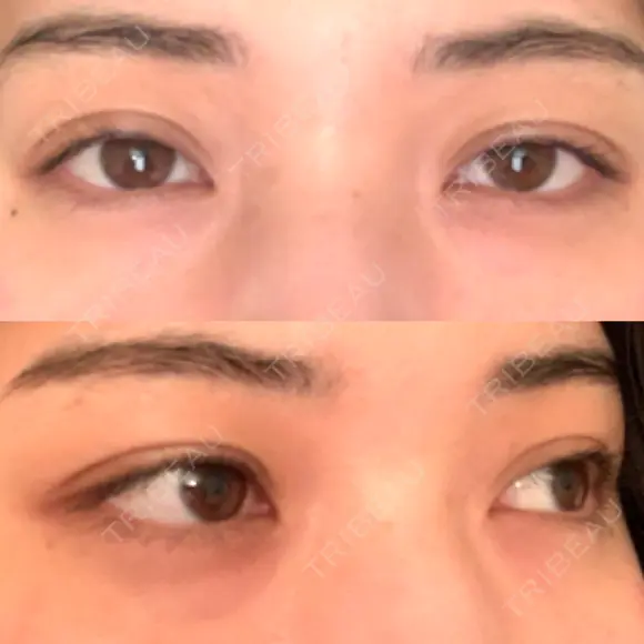 眼瞼下垂（切開） / 目尻切開 / タレ目形成・グラマラスライン（切開） プロミス整形外科 BEFORE メイン用