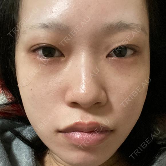 目頭切開 / 鼻尖形成（切開） / 額を丸く / 目尻切開 / 上まぶたの脂肪取り / 軟骨移植 / 脂肪注入（輪郭） TN整形外科 BEFORE メイン用