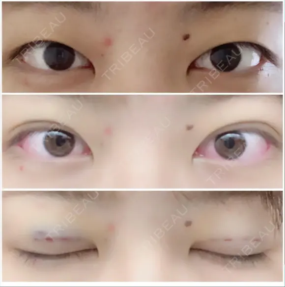 二重埋没 / 上まぶたの脂肪取り 湘南美容クリニック 柏院 BEFORE メイン用