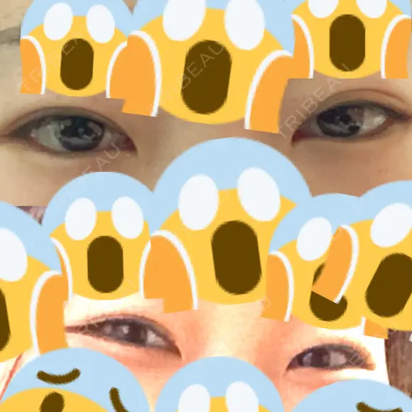 二重切開 / 目頭切開 / 鼻尖形成（切開） / 鼻中隔延長（切開） / 小鼻縮小（切開） / タレ目形成・グラマラスライン（切開） / 鼻尖縮小 / 鼻翼基部形成（貴族手術） グローバルビューティークリニック 大阪院 BEFORE メイン用