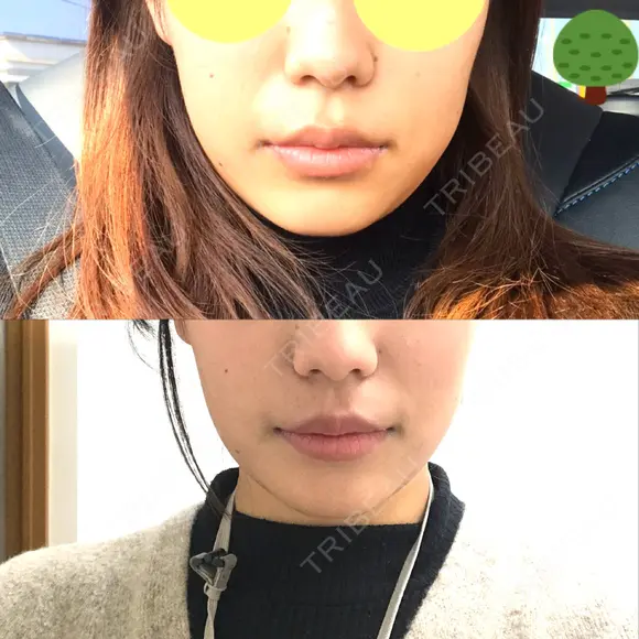 脂肪溶解注射（顔） / 美容点滴・美容注射（美肌） / ボトックス（肩） / ハイフ（顔） リエンジャン整形外科 江南店 BEFORE メイン用