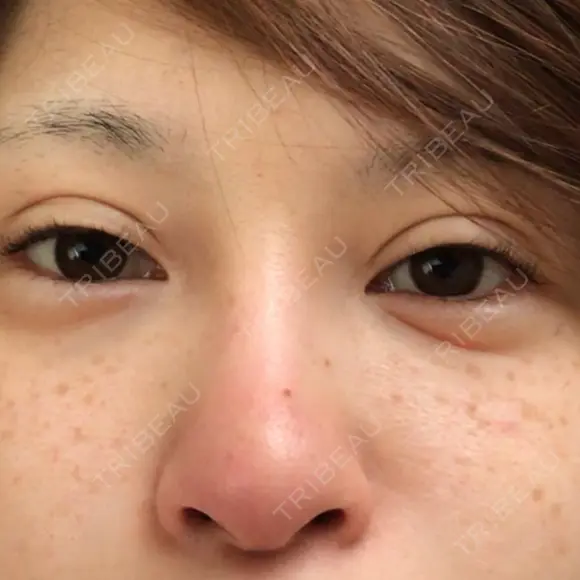 二重切開 / 隆鼻術 / 鼻中隔延長（切開） 牧野皮膚科形成外科内科医院 美容外科・形成外科・抗加齢医学外来 BEFORE メイン用