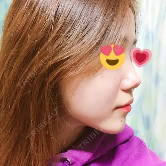 隆鼻術 / 鼻尖形成（切開） / 鼻中隔延長（切開） / 鼻孔縁挙上 ソウルリスタ整形外科 BEFORE メイン用