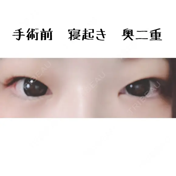 二重切開 / 目頭切開 / 上まぶたたるみ取り 湘南美容クリニック 金沢院 BEFORE メイン用